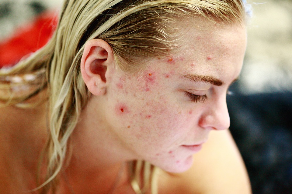 cicatrice d'acné